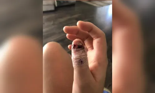 
							Moça de 20 anos tem dedo amputado após adquirir câncer por roer unhas em razão de bullying na escola
						
						