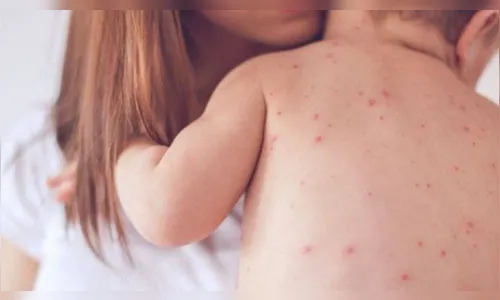 Brasil tem 2.044 casos confirmados de sarampo