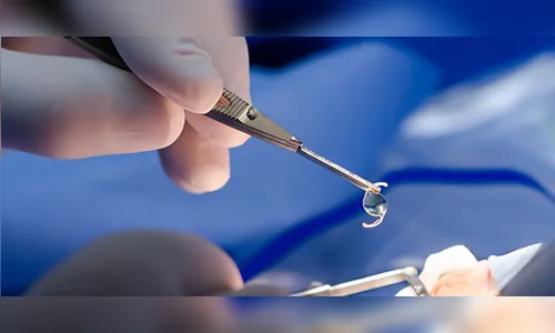 Governo  libera R$ 1,2 milhão para cirurgias de catarata na região de Maringá