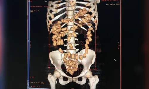 Paraguaia é presa com 87 cápsulas de cocaína no estômago, no PR