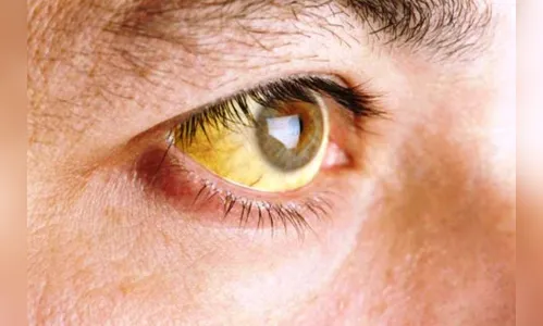 Paraná tem morte suspeita por febre amarela