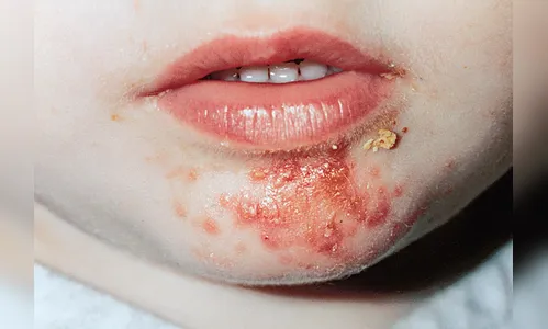 CMEI suspende atendimento após surto de doença contagiosa em Marumbi