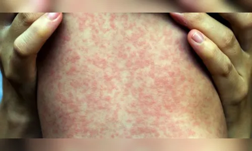 Casos de sarampo têm aumento de 300% no mundo, diz OMS