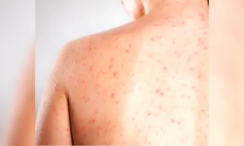 Sarampo: entenda os sintomas, riscos e tratamento