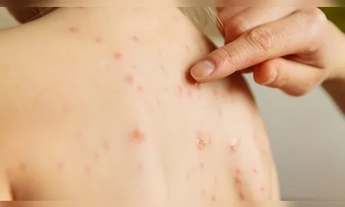 Sarampo tem crescimento exponencial no Paraná