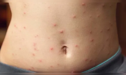 Ivaiporã intensifica vacinação contra sarampo