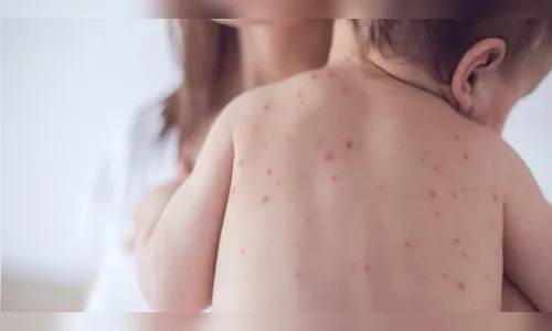 Pediatra orienta sobre o Sarampo