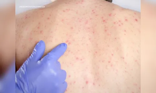 Paraná confirma 42 novos casos de sarampo 