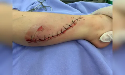 Menino de 4 anos tem perna rasgada por escada rolante durante passeio em shopping 