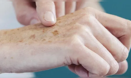 Medicina nuclear possibilita chances de cura para o câncer de pele