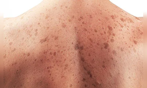 Dezembro Laranja: especialista da Unidade de Tratamento do Câncer de Apucarana orienta sobre câncer de pele