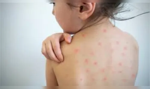 Paraná confirma mais 25 casos de sarampo em uma semana