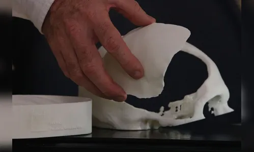 Brasileiros desenvolvem tecnologia de reconstrução craniana