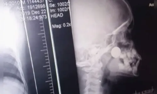 Menino fica dois dias com moeda presa dentro do nariz, e retirada é feita após espirro, em Itumbiara