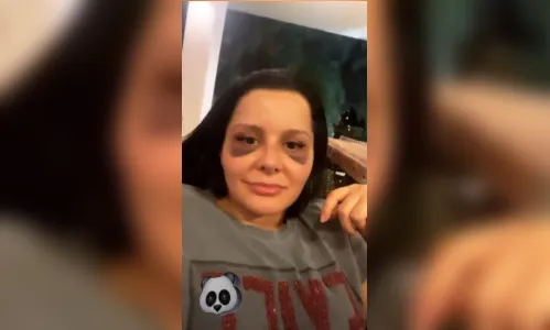 
							Maraisa impressiona ao exibir clique com manchas roxas na face após cirurgia plástica no nariz
						
						