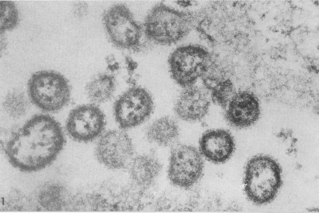 Novo vírus provoca primeiro caso de febre hemorrágica brasileira em 20 anos