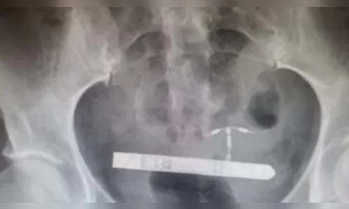 Mulher passa por cirurgia às pressas depois de vibrador parar na bexiga