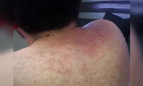 Paraná registra 808 casos de sarampo, aponta relatório da Secretaria de Saúde