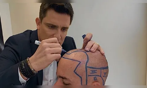 Dr. Carmelo, da Clínica Harmonia, é referência nacional em Transplante Capilar