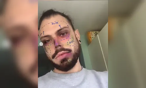 Instagram vai banir filtros que simulam cirurgias plásticas do Stories