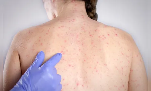 Paraná registra 19 novos casos de sarampo na última semana