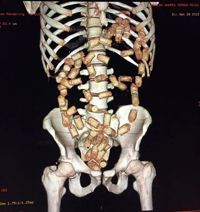 PF submeteu o suspeito ao aparelho body scan que indicou a presença de corpos estranhos na região abdominal de rapaz paraguaio - Foto: Divulgação/PF