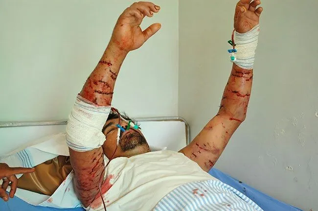 Homem atacado por pitbulls  na região continua internado - Foto: Blog do Berimbau