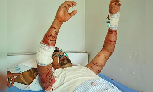 Homem atacado por pitbulls  na região continua internado