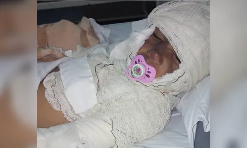 Três crianças e uma moça sofrem queimaduras após explosão