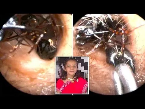 Uma garota de 12 anos possui uma colônia de formigas vivendo dentro de sua cabeça. Foto: Google Imagens