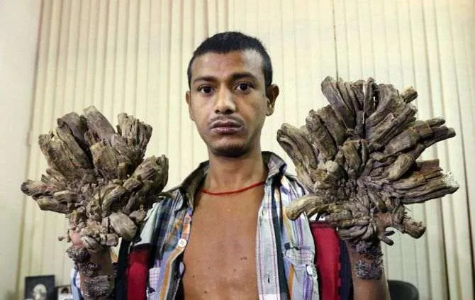 Abul Bajandar, um homem de 27 anos conhecido por homem-árvore, está próximo de voltar para casa - Foto: portal abola.pt
