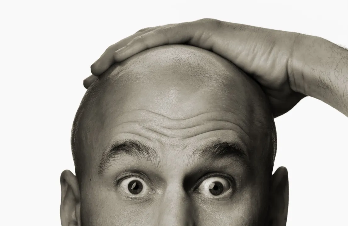 Altos níveis de estresse estão relacionados com a queda de cabelo