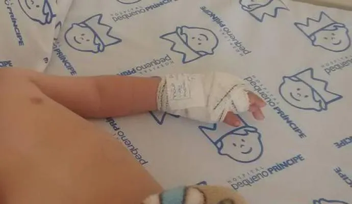 Enfermeira cortou o dedo do bebê com uma tesoura no momento em que tirava o acesso do cateter da criança - Foto: Reprodução