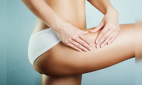 Método Natural para acabar com as estrias 