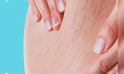 Sinta-se ainda mais bonita livre das estrias! 