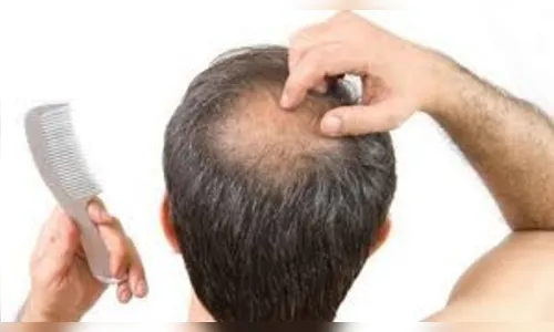 Forma Natural de Evitar a Queda de Cabelo e a Calvície 