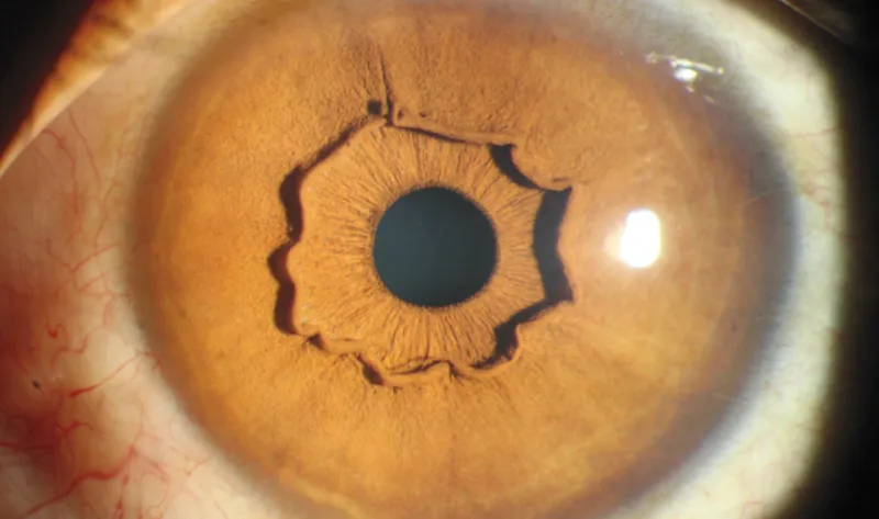 Imagem mostra o “colarinho da íris saliente” no olho esquerdo de chinesa - Foto:New England Journal of Medicine
