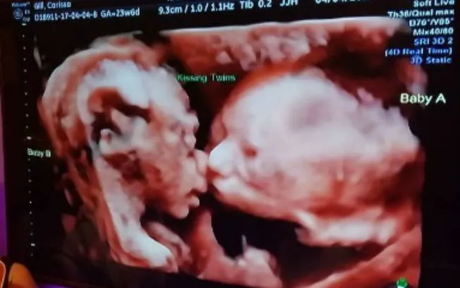 Ultrassom mostra gêmeas dando beijo dentro do útero