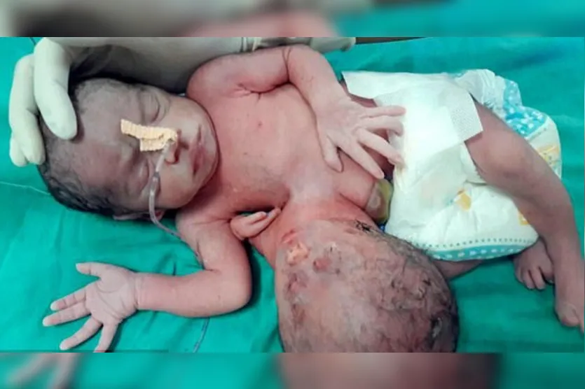   Bebê do sexo feminino nasceu com duas cabeças e três braços - Rareshot News - SWNS.com 