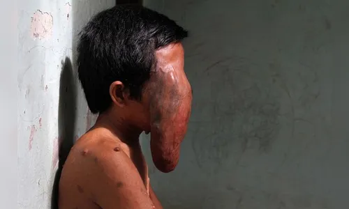 Homem que teve rosto tomado por tumor pede ajuda na internet; veja vídeo