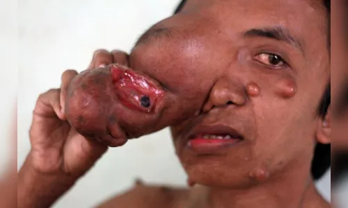 
							Homem que teve rosto tomado por tumor pede ajuda na internet; veja vídeo
						
						